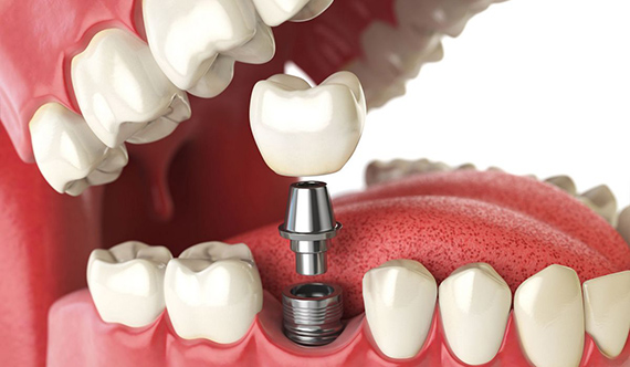 схема установки зубного протеза на имплант